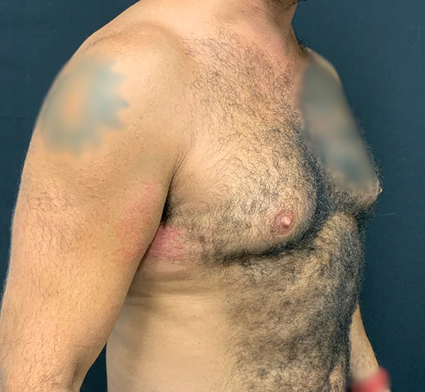 Gynecomastia