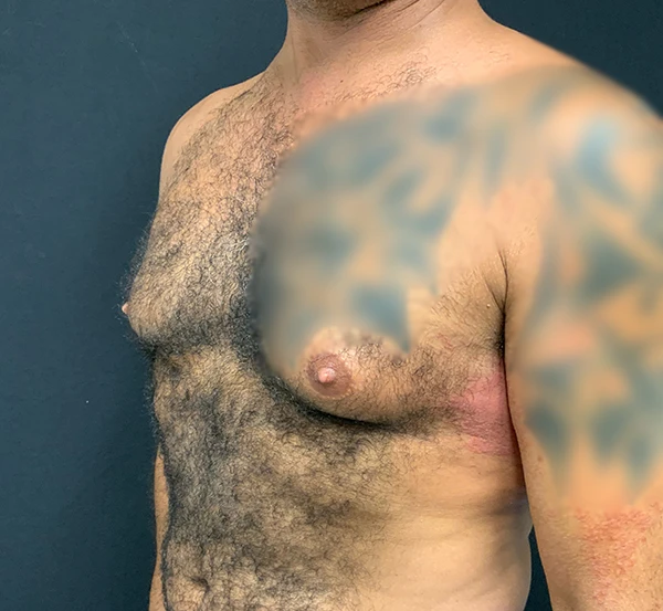 Gynecomastia