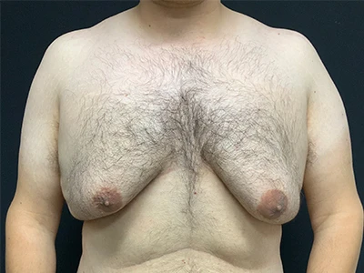 Gynecomastia