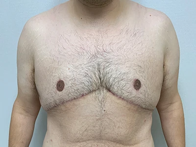 Gynecomastia