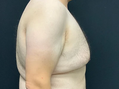 Gynecomastia