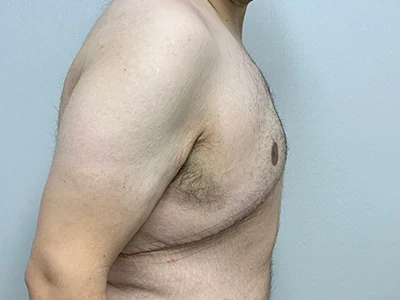 Gynecomastia