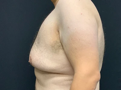 Gynecomastia