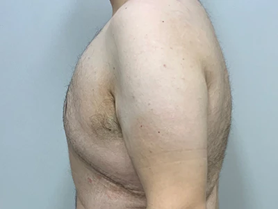 Gynecomastia