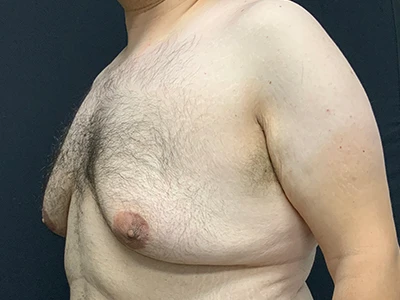 Gynecomastia