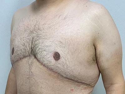 Gynecomastia