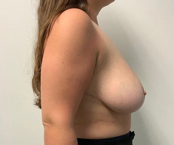 Breast Reduction
