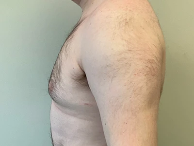 Gynecomastia