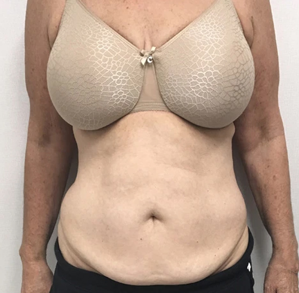 Tummy Tuck