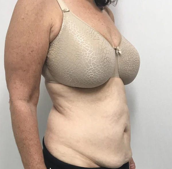 Tummy Tuck