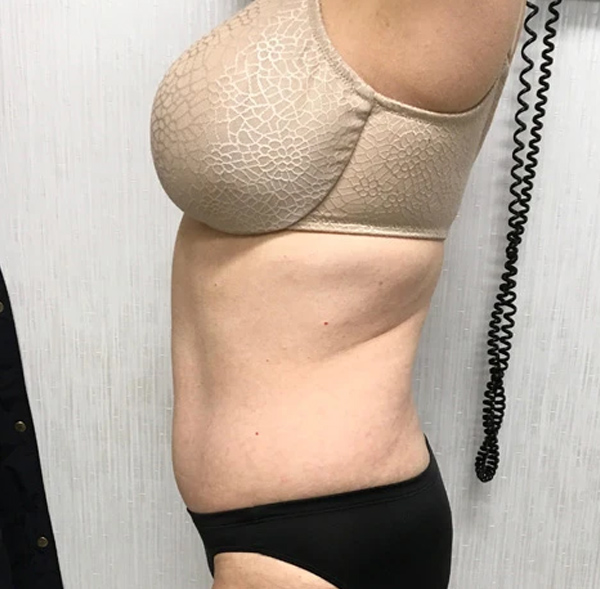 Tummy Tuck