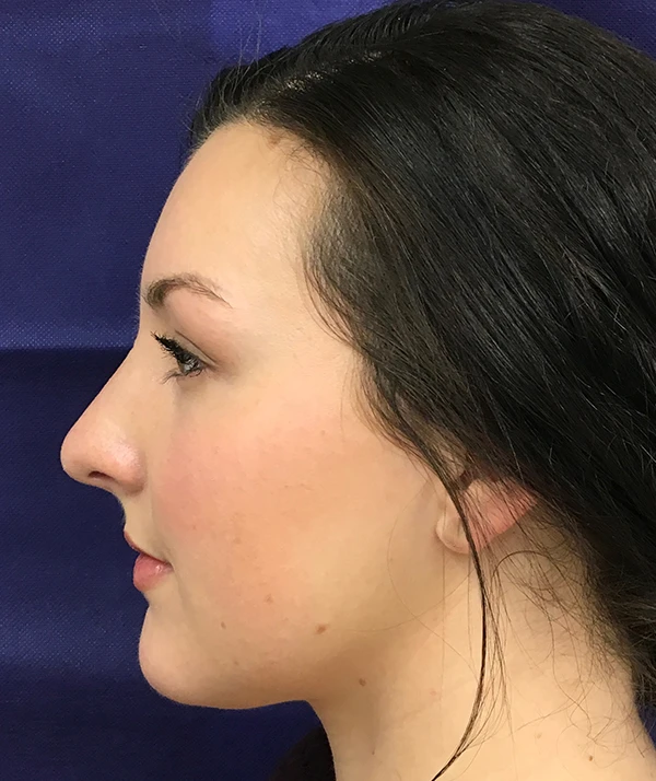 Rhinoplasty