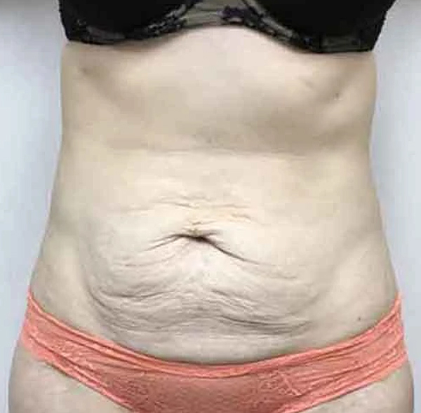 Tummy Tuck