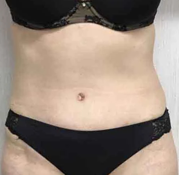 Tummy Tuck