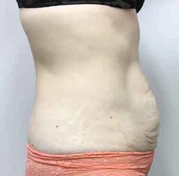 Tummy Tuck