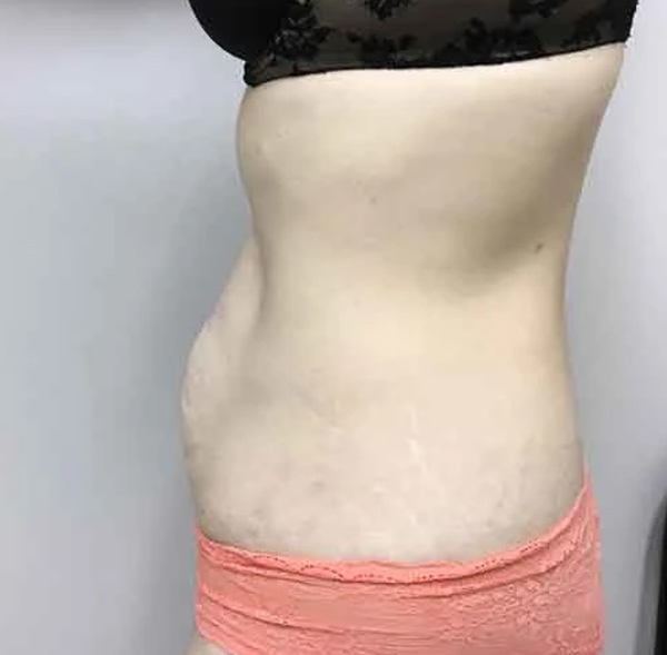 Tummy Tuck