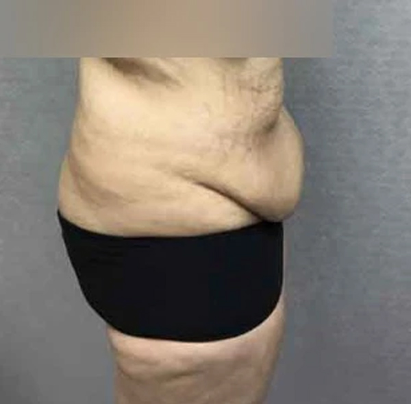 Tummy Tuck