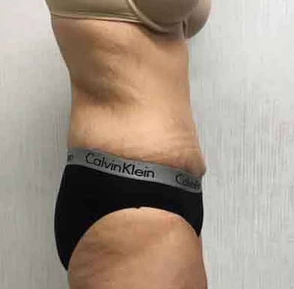 Tummy Tuck