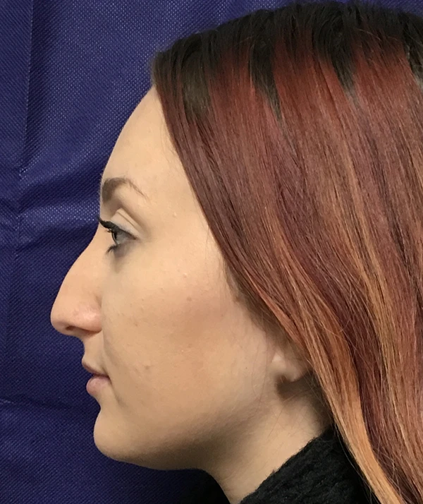 Rhinoplasty