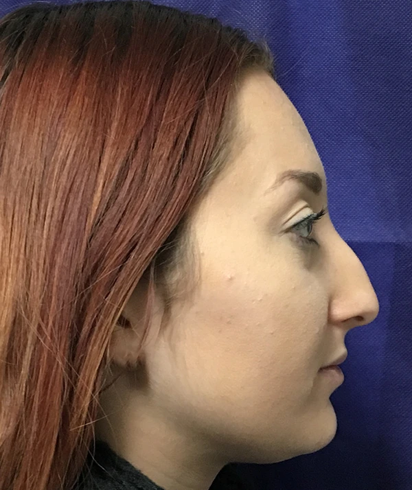 Rhinoplasty