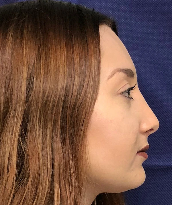 Rhinoplasty