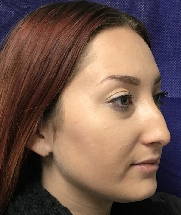 Rhinoplasty