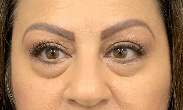 Blepharoplasty