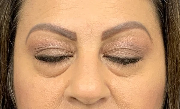 Blepharoplasty