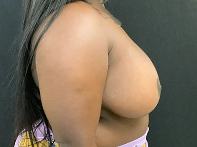 Breast Lift
