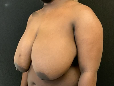 Breast Lift