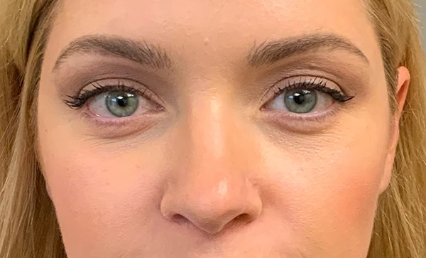 Blepharoplasty