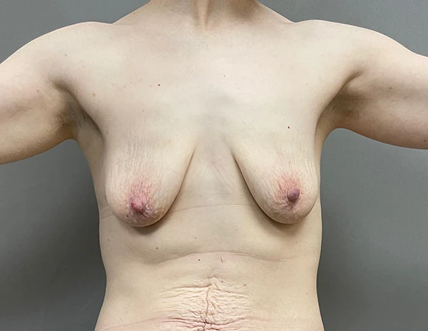 Breast Augmentation with Lift