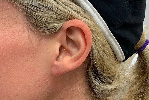 Earlobe Repair