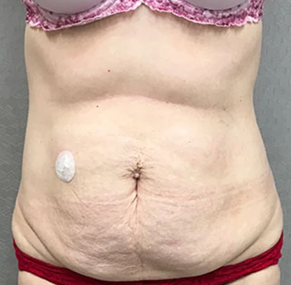 Tummy Tuck