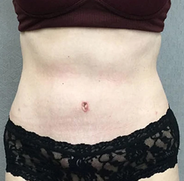 Tummy Tuck