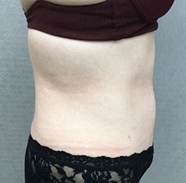 Tummy Tuck