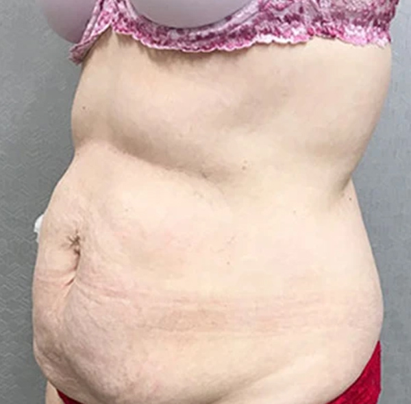 Tummy Tuck