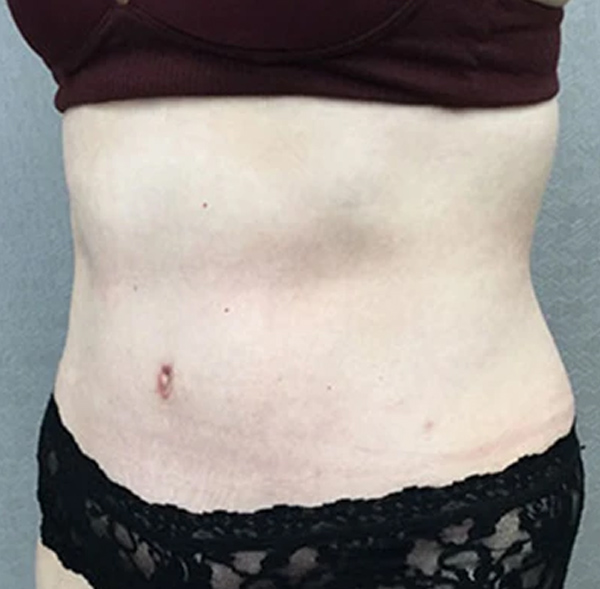 Tummy Tuck