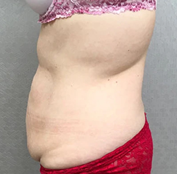 Tummy Tuck