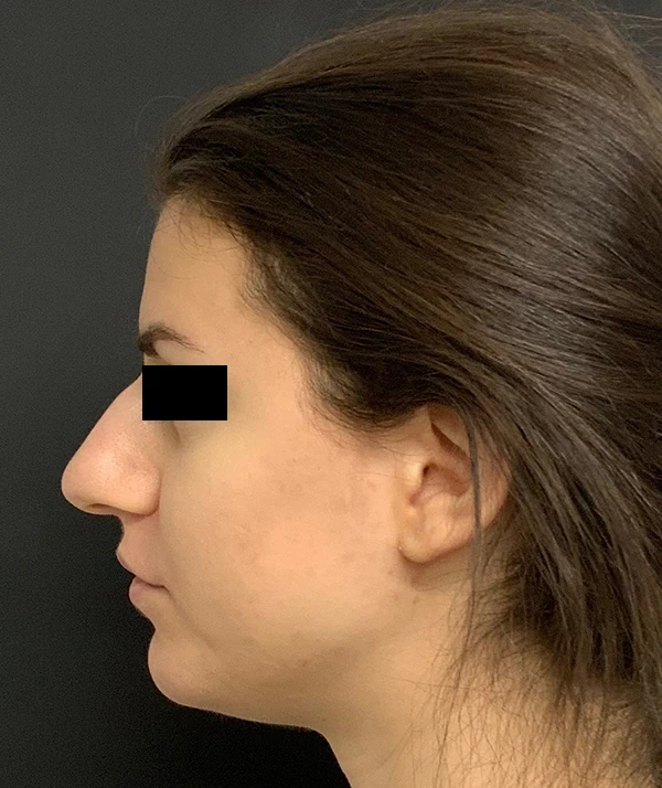 Rhinoplasty