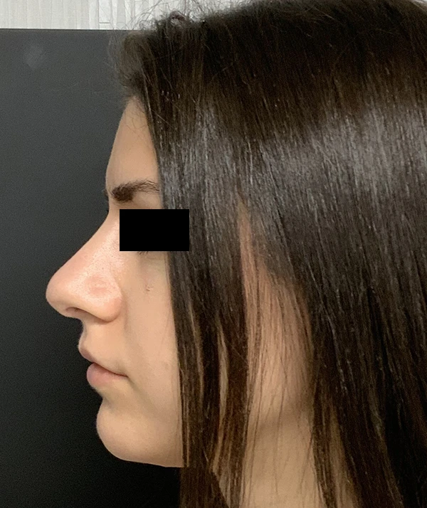 Rhinoplasty