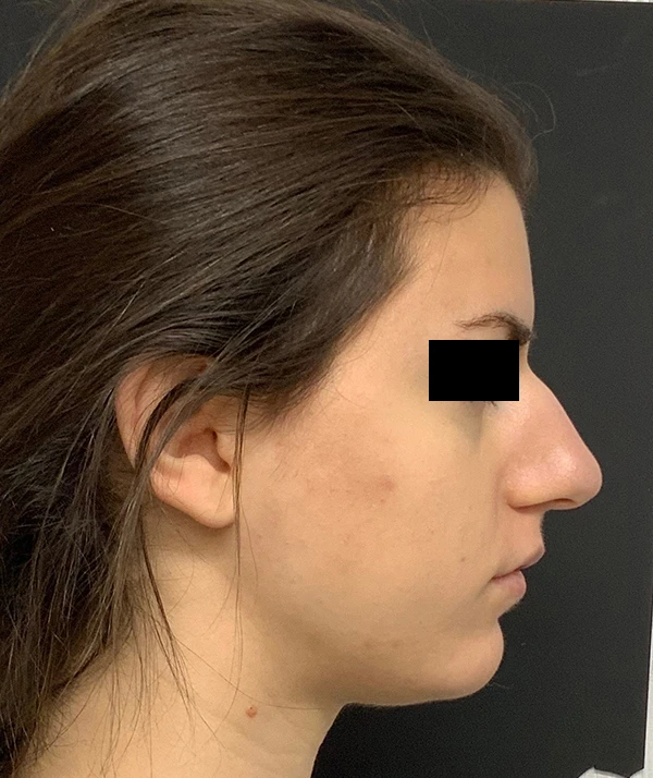 Rhinoplasty