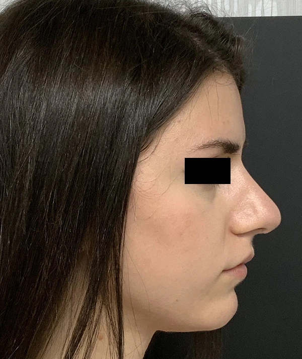 Rhinoplasty