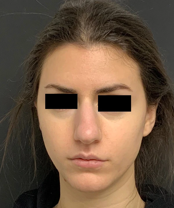 Rhinoplasty