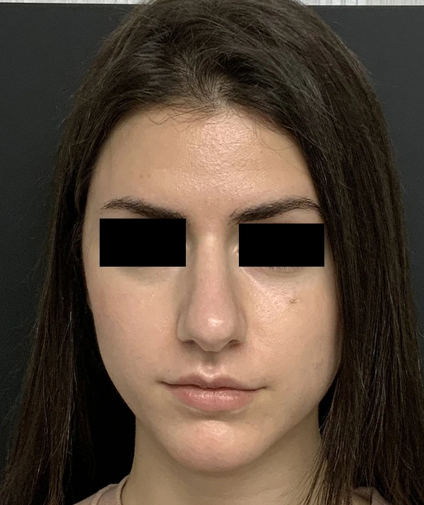 Rhinoplasty