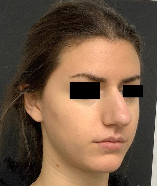 Rhinoplasty