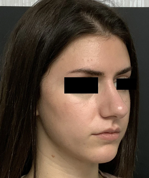 Rhinoplasty