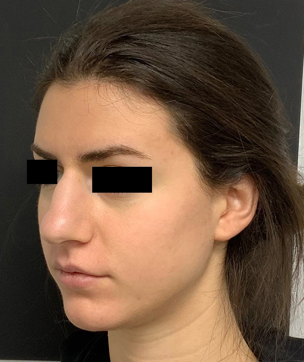 Rhinoplasty