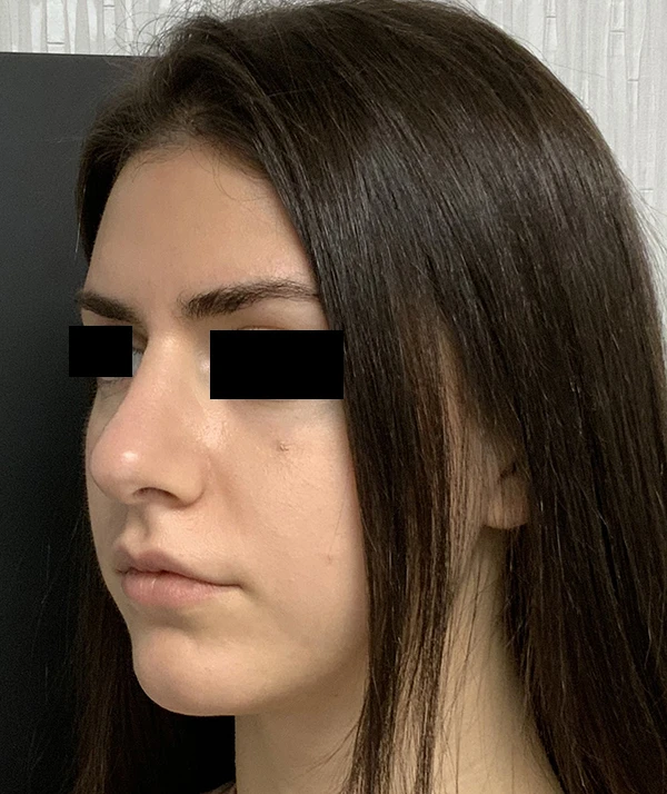 Rhinoplasty