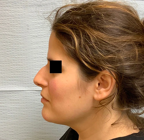 Rhinoplasty